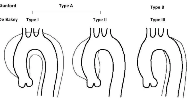 Figure 1. Classifications des dissections aortiques aiguës 