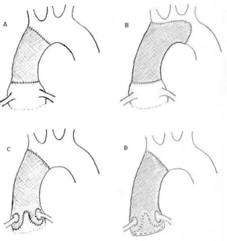 Figure 4. A : remplacement de l’aorte ascendante, B : remplacement de l’aorte ascendante et de la  concavité de la crosse aortique, C : intervention de Yacoub, la prothèse est suturée au pourtour de la  valve aortique, D : intervention de David, la valve a