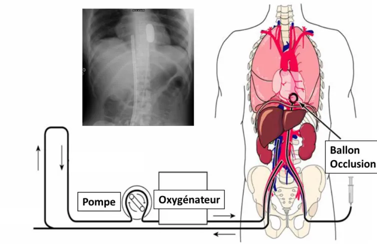 Figure 2 : Circulation Régionale Normothermique : Principe et contrôle radiographique 