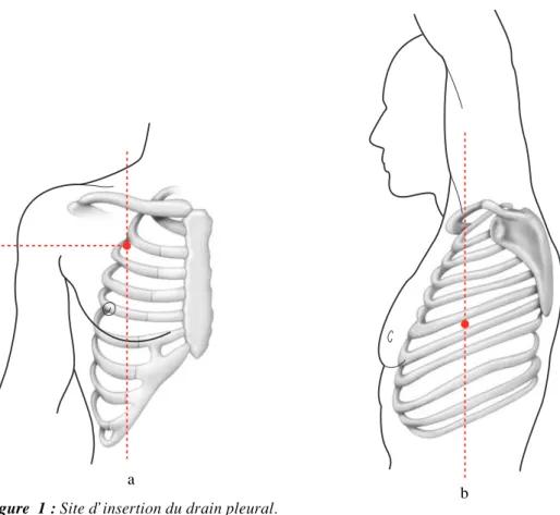 Figure  1 : Site d’insertion du drain pleural.