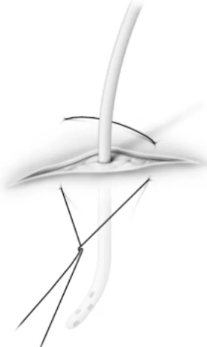 Figure 4 : Points de suture de fixation en U autour du drain pleural
