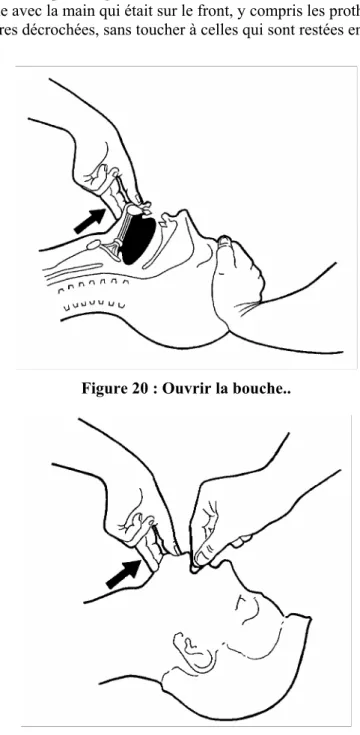 Figure 20 : Ouvrir la bouche.. 