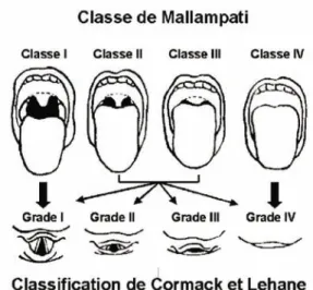Figure 1. Classe de Mallampati.