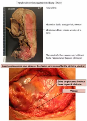 Figure 3. a.  Placenta increta et percreta : vue macroscopique peropératoire et examen  anatomopathologique.b