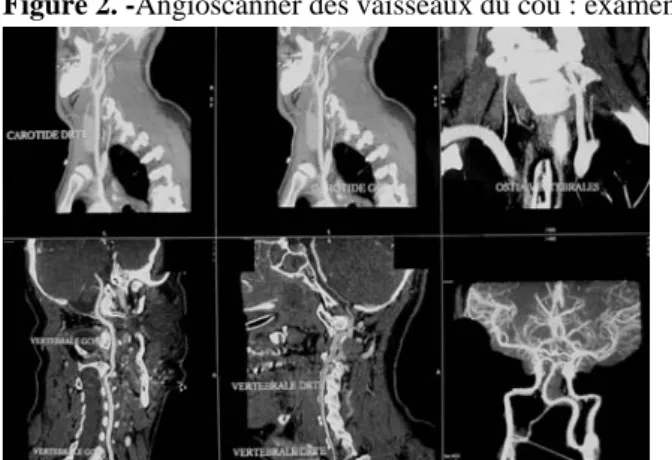 Figure 2. -Angioscanner des vaisseaux du cou : examen normal
