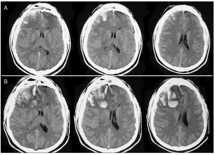 Figure 3. - Evolution temporelle d’une contusion hémorragique entre h2 (A) et h16 (B) post-traumatique 