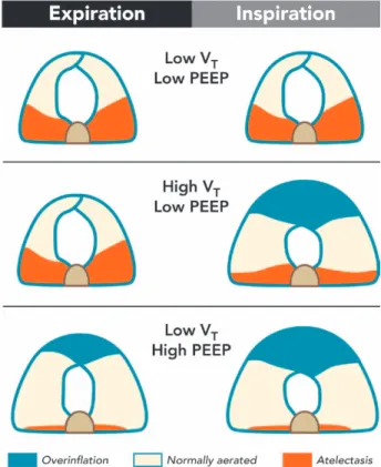 Fig. 3.  Effects of high and low tidal volumes (V T ) at end- 