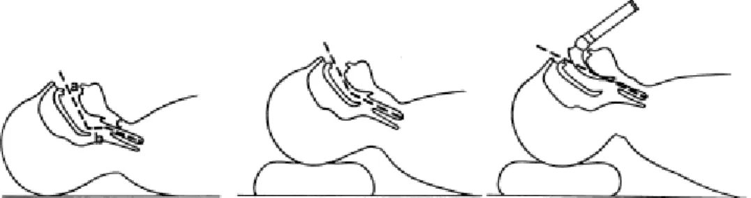 Fig 1. Position modifiée de Jackson. La position de la tête, la mise en plaœ d' un coussin sous  l'occiput et le laryngoscope permettent d'aligner les trois axes (a: axe buccal; b: axe pharyngé;  c: axe laryngé) et de visualiser la glotte 