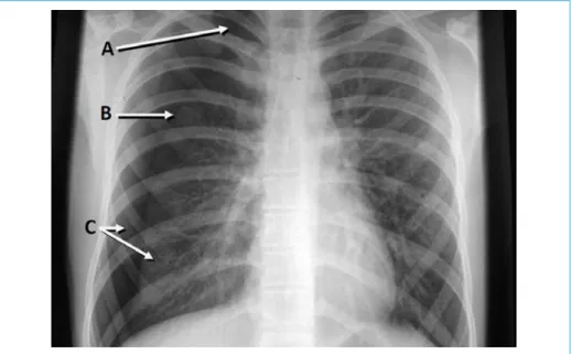 Figure 4 –  Diagnostic radiologique du pneumothorax. A : Hyperclarté ; B : Liseré dense  de la plèvre viscérale ; C : Absence d’arbre broncho-vasculaire.