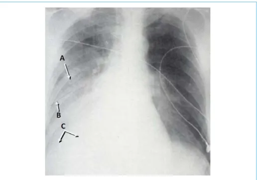 Figure 5 –  Diagnostic d’un hémothorax sur une radiographie en décubitus dorsal. A : Augmentation de la densité de l’hémithorax ; B : Accentuation de la petite scissure ; C : Perte de la silhouette diaphragmatique.
