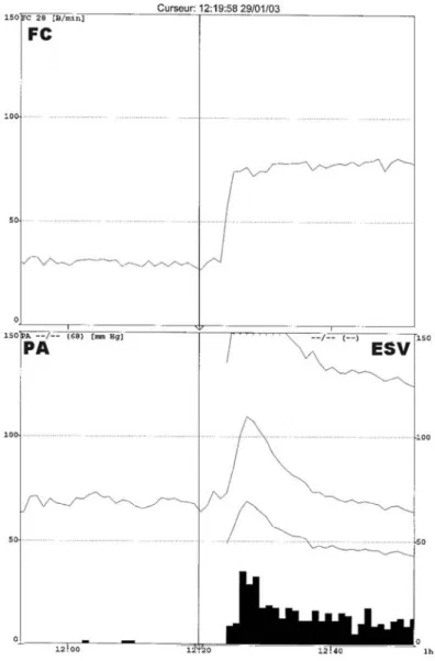 Fig. 6 – Courbe de tendance de la fréquence cardiaque (FC), de la pression artérielle (PA) et