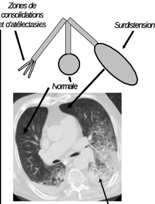 Figure 1.- Hétérogénéité pulmonaire au cours du SDRA. 