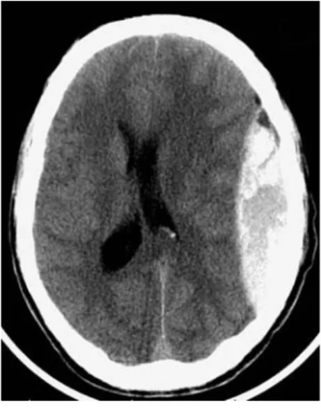 Fig. 3 – HED : collection extracérébrale, en