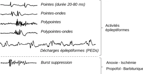 Figure 6 - Aspect des différentes activités épileptiformes observées en intercritique et des « burst  suppression »