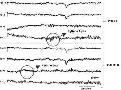 Figure 1 - EEG Normal. L’EEG 