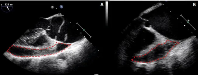Figure  8  :  Pathologies  de  l’aorte  thoracique  ascendante  (AAA)  compliquées  d’un  épanchement  péricardique