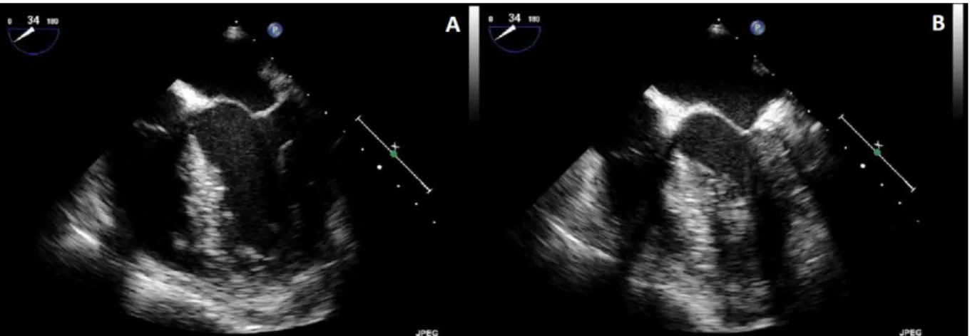 Figure  1  :  Indices  échocardiographiques  d’hypovolémie.  A  :  coupe  médio-oesophagienne  à  0°  en  ETO  objectivant  des  cavités  ventriculaires  de  petite  taille  en  télédiastole