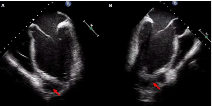 Figure  4  :  Anévrysme  ventriculaire  gauche  apical  compliquant  un  IDM.  A  :  coupe  médio- médio-œsophagienne  à  0°  en  ETO  objectivant  l’anévrysme  partiellement  thrombosé  (flèche)