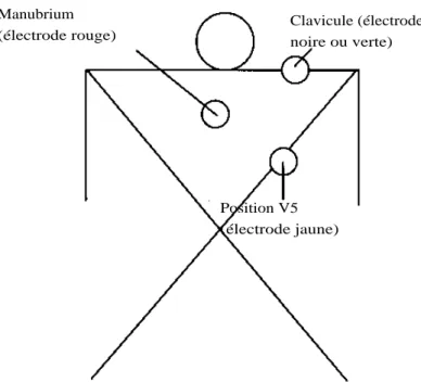 Figure 6 - Dérivation CM5 : emplacement des électrodes