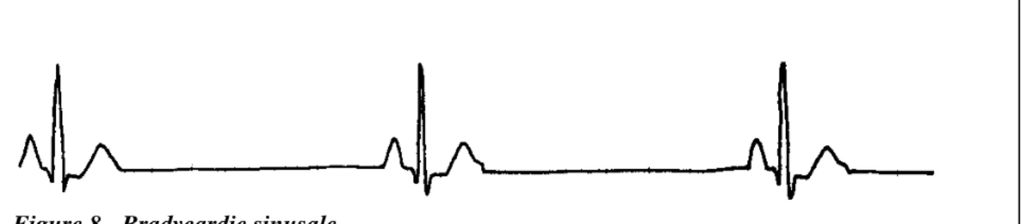 Figure 8 - Bradycardie sinusale