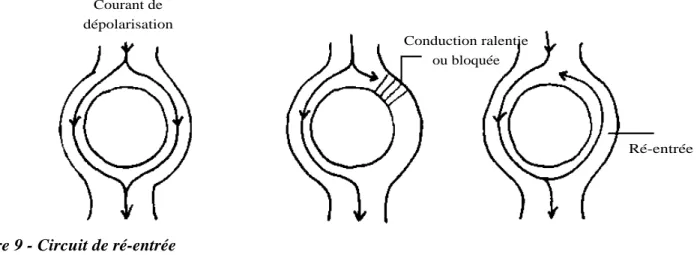 Figure 10 - Tachycardie jonctionnelle