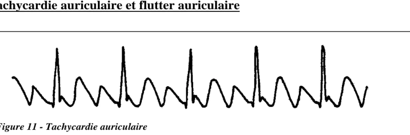 Figure 11 - Tachycardie auriculaire