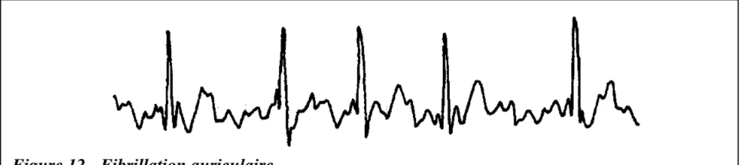 Figure 12 - Fibrillation auriculaire