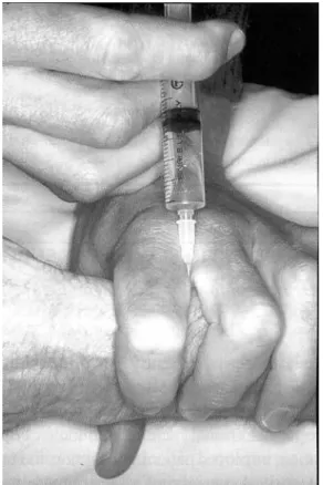 Figure 3 - Bloc du nerf radial au poignet