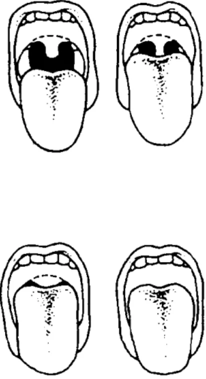 Figure 8 - Classification modifiée de Mallampati de l’aspect du pharynx