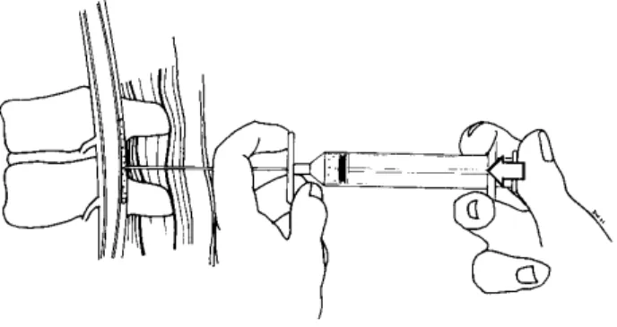 Figure 4. technique de recherche de l’espace péridural par la perte de résistance