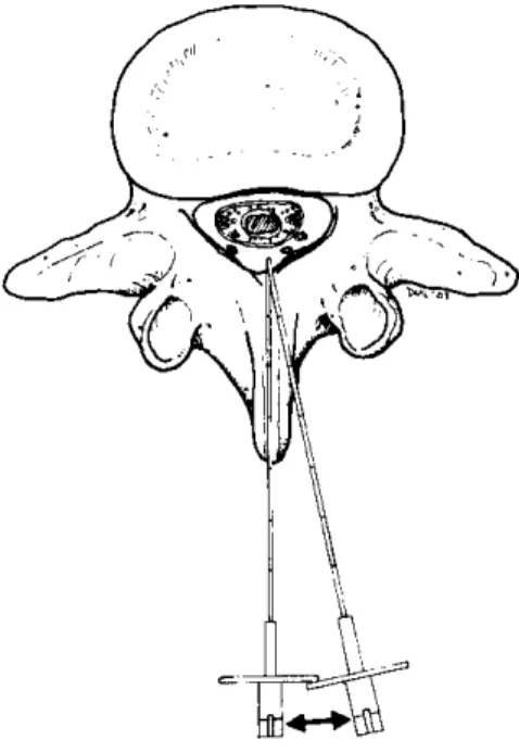 Figure 6. Abord médian vs. paramédian