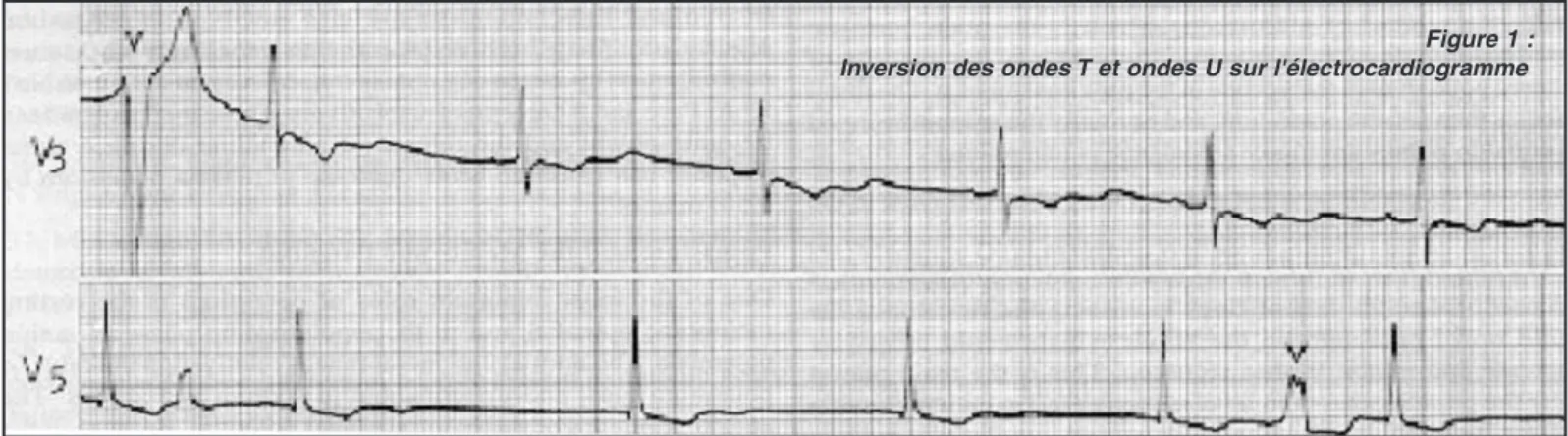 Figure 1 : Inversion des ondes T et ondes U sur l'électrocardiogramme