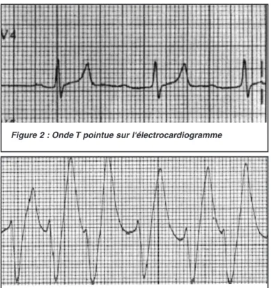 Figure 2 : Onde T pointue sur l'électrocardiogramme
