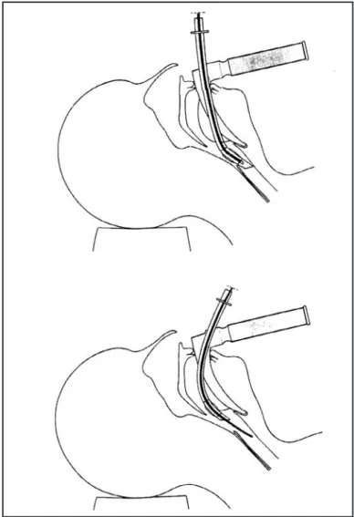 Figure 2a : Intubation avec mandrin. 2b :Intubation avec bougie