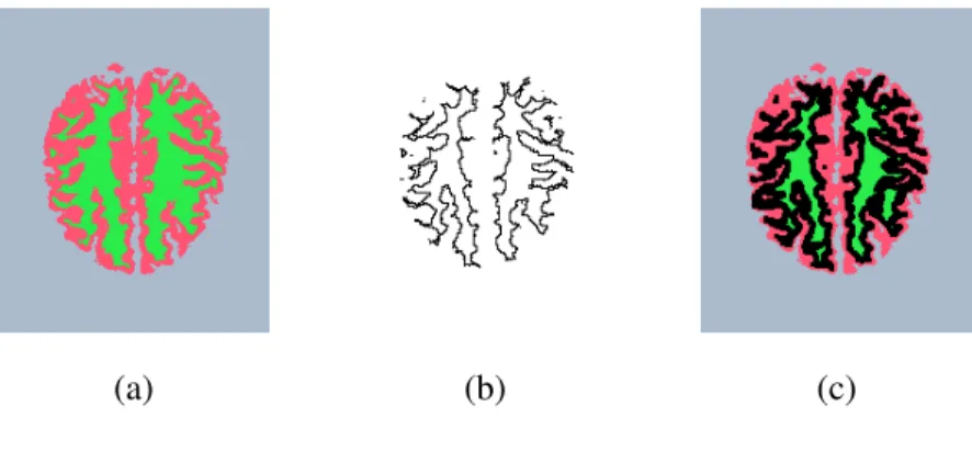 Fig. 5. Morphological dilation affects the topology structure of evolving fronts and also affects the accuracy of segmentation results