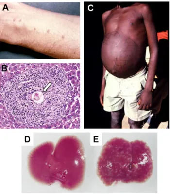 Figure 13 : Exemple de symptômes observables lors d’une infection par S. mansoni. A. Rash observé suite à la 