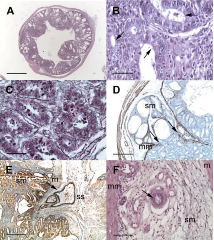 Figure 1 : Observation microscopique du développement des lésions néoplasiques iléo- iléo-caecales chez des souris SCID infectées par C