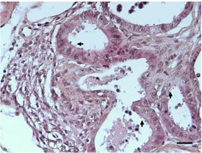 Figure 3. Ileo-caecal neoplastic lesions in a dexamethasone-treated SCID mice infected  with C