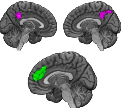 Figure 2 : clusters montrant une diminution significative de l'activation similaire entre les groupes TPB et PTSD (violet) par  rapport aux sujets témoins dans les précuneus gauche et droit