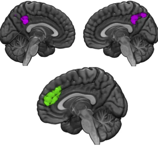Fig. 3. Clusters showing signiﬁcant shared decreased activation in both BPD and PTSD (purple) groups relative to control subjects in left and right precuneus (MNI coordinates: 0, -46, 38; 606 voxels)