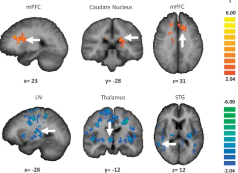 Figure 1. Whole-brain voxel-based comparisons of the hippocampal functional connectivity in schizophrenia patients with auditory-only (AH, n ¼ 17) or audio-visual (A þ VH, n ¼ 16) hallucinations