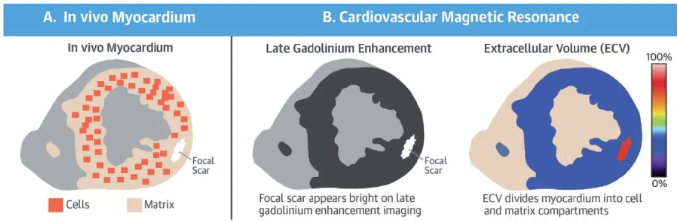 Figure 12.  Caractérisation du myocarde en IRM cardiaque, d’après Treibel et al. (1) 