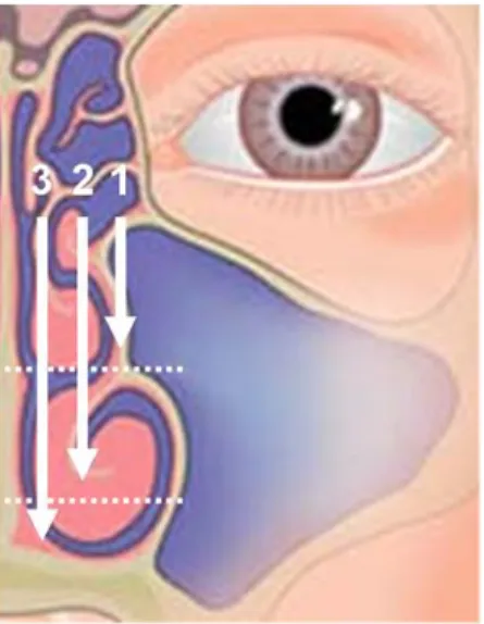 Figure 3: Score de taille des polypes selon Lildholdt. 