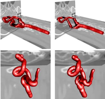 Figure 3: Three dimensional view of initial segmentation with fast marching method (left) and refined segmentation with level sets (right) on data 022 (first line), and data 107 (second line).