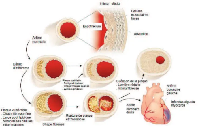 Figure  10 :  Evolution  progressive  de  la  plaque  d’athérosclérose vers  un  phénotype  « stable » ou « vulnérable », adapté de (Libby, 2002) 