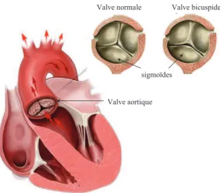 Figure 15 : Schéma d’une valve aortique normale et d’une valve bicuspide, d’après (CC,  2015) 