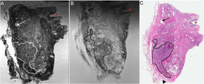 Figure 12 - Image en écho de gradient de 7 Tesla d'un échantillon obtenu à partir de la section de  prostatectomie radicale robot avec un cancer de la prostate de haut grade  
