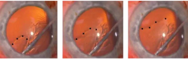 Figure 1: L’hydrodissection est une étape de l’opération de la cataracte permettant de séparer le cristallin de son  enve-loppe : un fluide est injecté entre le cristallin et la capsule ; à gauche anatomie de l’oeil ; à droite plusieurs instants lors de la