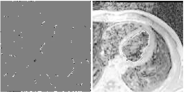Figure 8: Heart ventricle detection: To nd the second end point, saddle point classication is used on the left