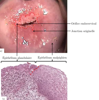 Figure I.5 : Jonction cylindro-malpighienne en pointillé rouge, a) photographie d’un col vu de face, b) coupe  histologique